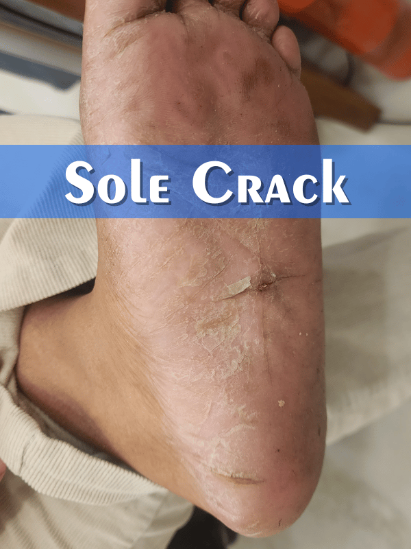 Sole Crack Treatment